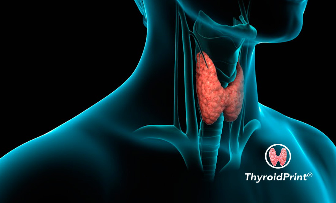 ThyroidPrint: the test that identifies with high accuracy whether a thyroid nodule is benign or not