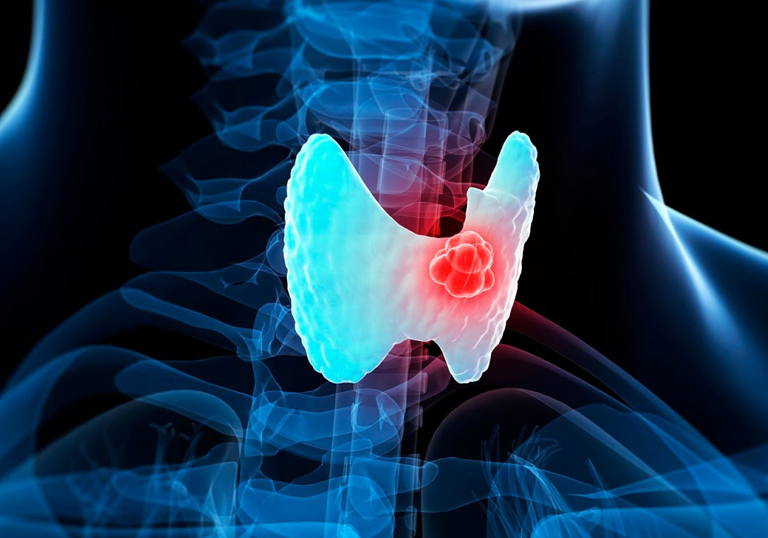 Genetic test will allow to determine with accuracy if someone has thyroid cancer