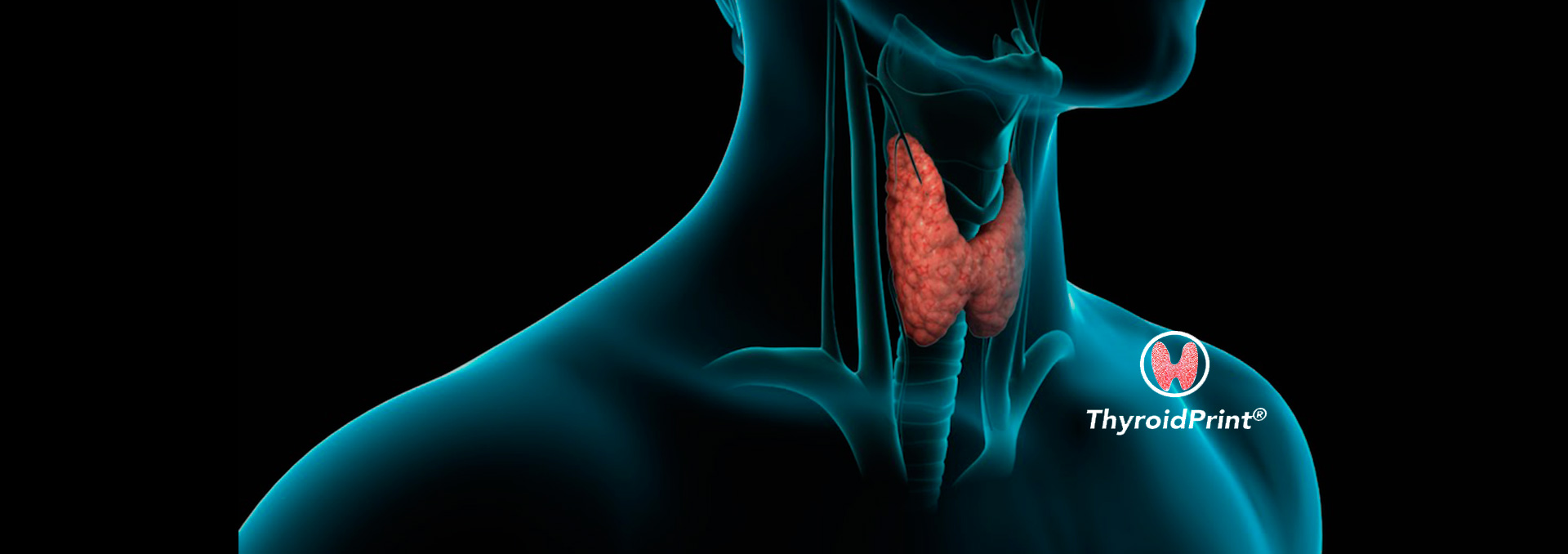 ThyroidPrint: the test that identifies with high accuracy whether a thyroid nodule is benign or not