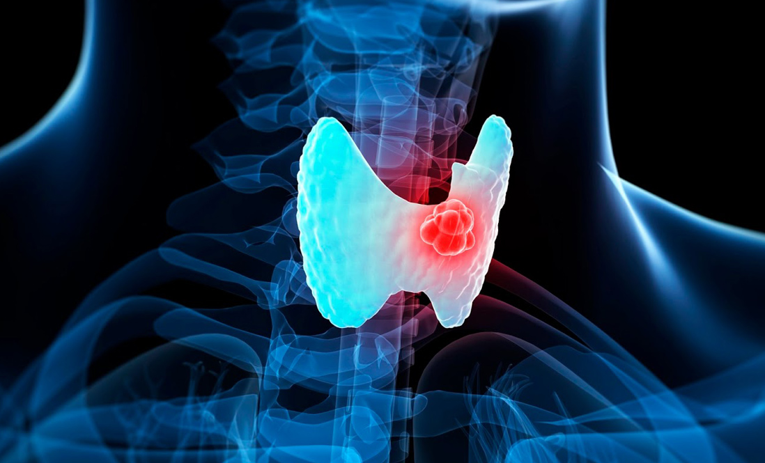 Genetic test will allow to determine with accuracy if someone has thyroid cancer