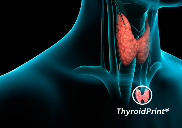 ThyroidPrint: el test que identifica con alta Exactitud si un nódulo tiroideo es benigno o no